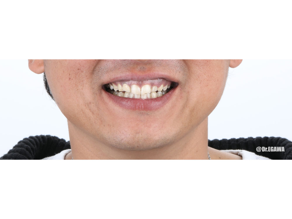 前歯のセラミック治療の症例