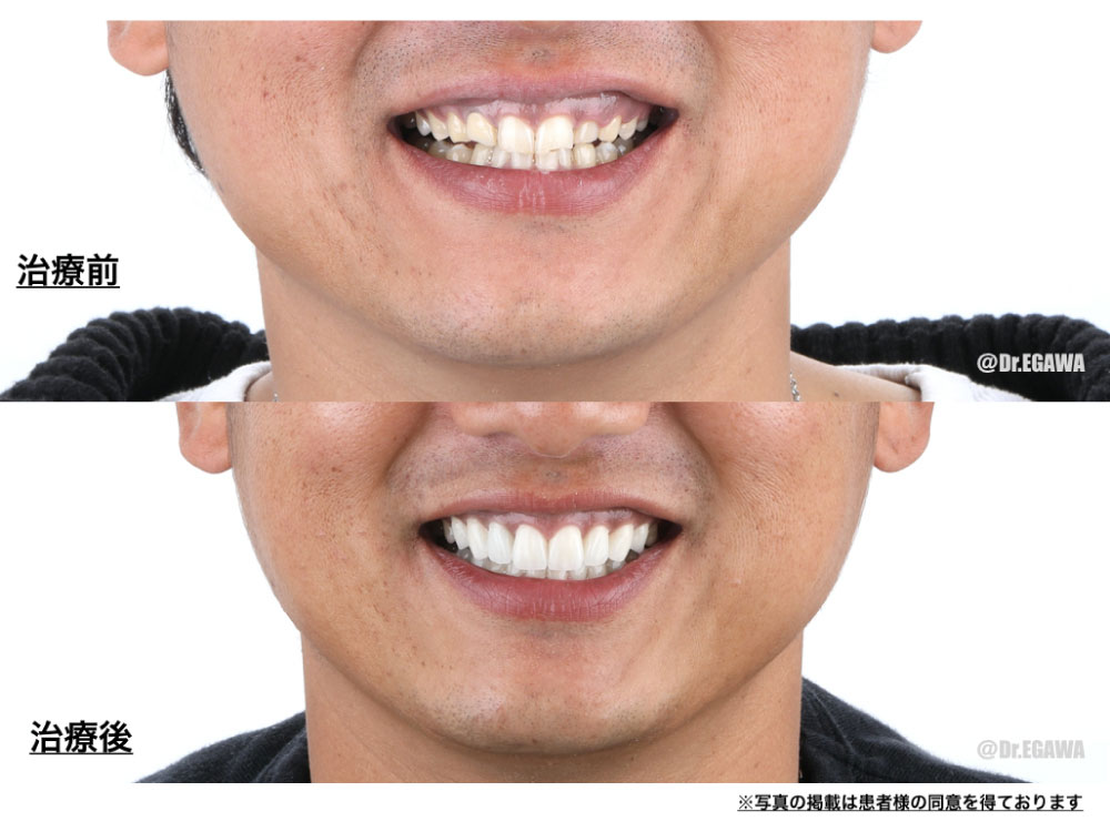 前歯のセラミック治療の症例