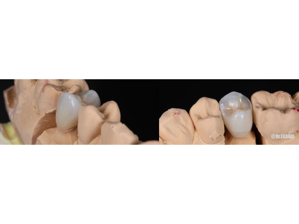 奥歯のセラミック治療の症例