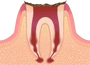 むし歯が進行して歯の根だけになっている歯