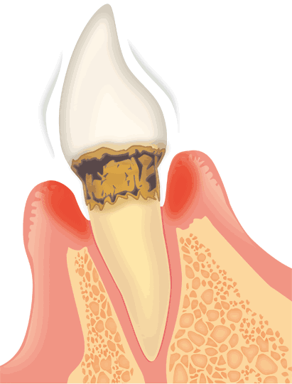 歯周病で抜歯が必要な歯