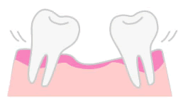 治療を放置して抜けそうな歯