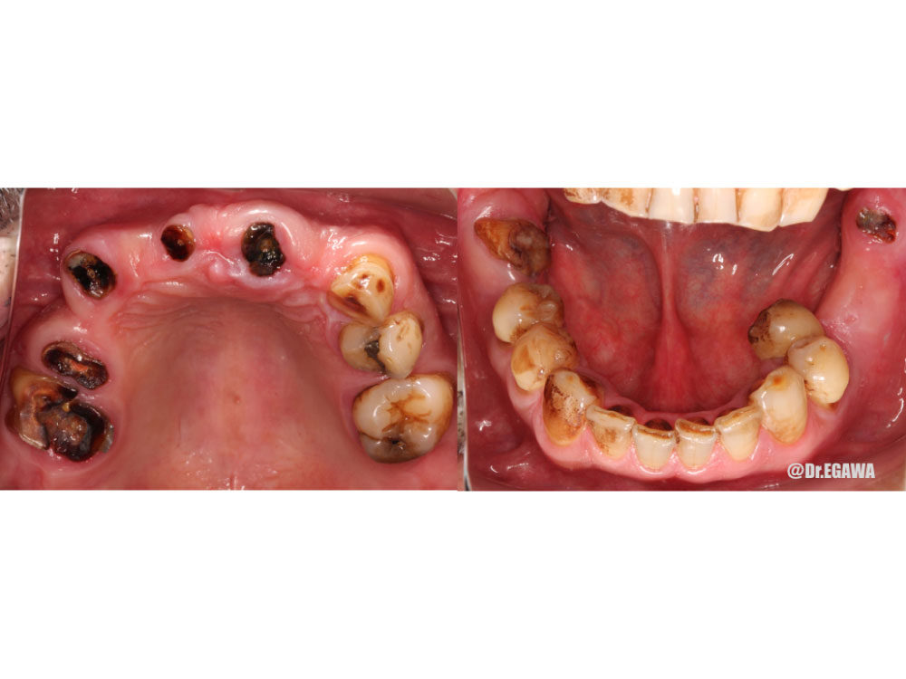 不幸にして多くの歯を失ってしまった方の再構築の症例