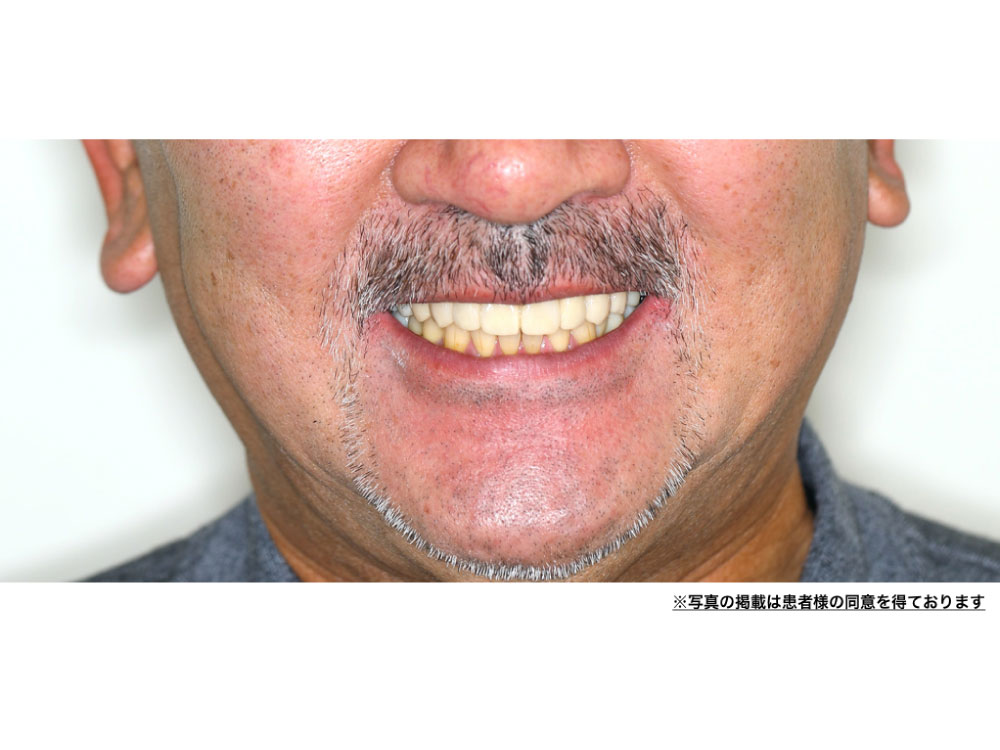 不幸にして多くの歯を失ってしまった方の再構築の症例