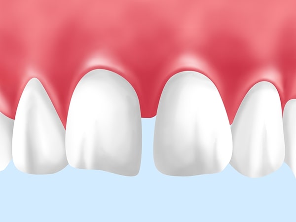 そもそも「すきっ歯」って？